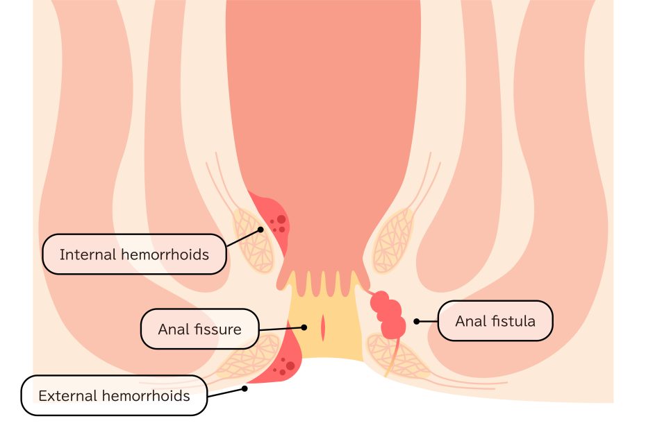 এনাল ফিসার হলে কোন ডাক্তার দেখাবো